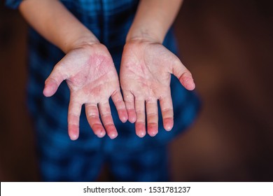 
Scarlet Fever. Two Hands With A Contagious Red Small Rash And Shabby Skin