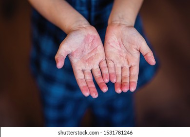 
Scarlet Fever. Two Hands With A Contagious Red Small Rash And Shabby Skin