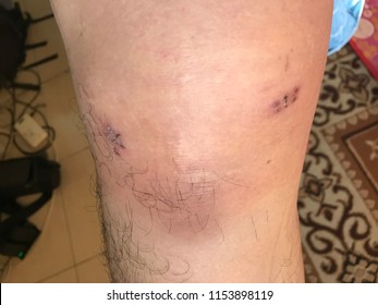 Scarring effect from stitches after knee arthroscopy surgery - meniscus repair and chondro plasty
