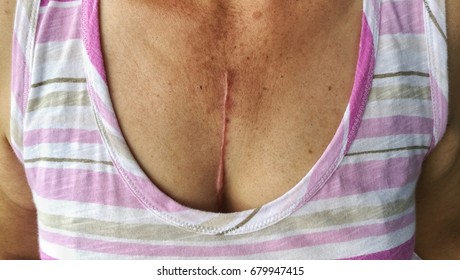 Scars From Cardiac Surgery In Asian Elder Woman 