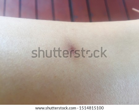Scars from hot glue on leg,selective focus