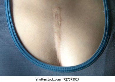 727573027. Narben auf der Brust einer Frau, die durch Tumoroperationen im H...