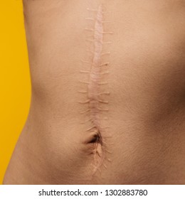 scars removal concept, large scar after surgery on the abdomen young woman, yellowl background, selective focus