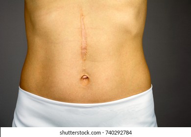 scars removal concept, large scar after surgery on the abdomen young woman, blurred neutral background, selective focus