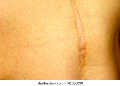 Appendicitis Scar Images, Stock Photos & Vectors | Shutterstock