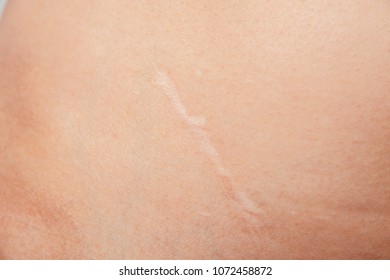 Scars removal concept. Young woman with large scar after surgery on abdomen, removal of appendicitis.
