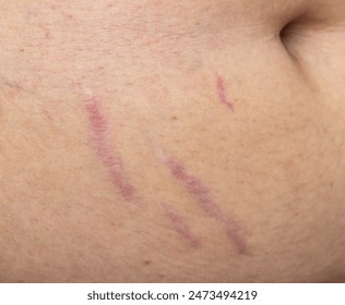 scars from stretch marks on the skin of the abdomen