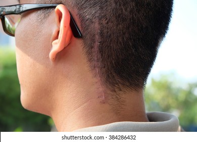 Scars From Surgery Brain Tumors