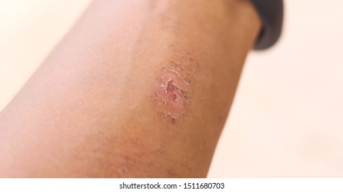 249 Dry wound dressing Images, Stock Photos & Vectors | Shutterstock