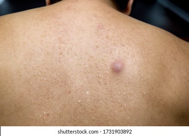 Big Pimple High Res Stock Images Shutterstock