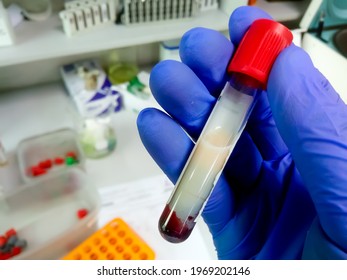 Scientist or Biochemist hold test tube with Lipemic blood sample. High Triglyceride contain blood sample. Lipid profile