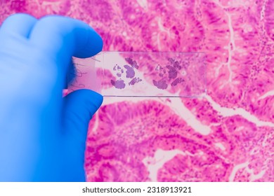 Scientist in blue gloves hand holding glasses slide breast tissue on out of focus cancer tissue picture background.Pathologist hand in glove holding glass organ samples.Histological examination. - Powered by Shutterstock