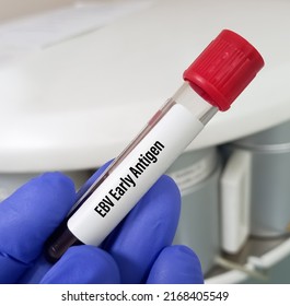 Scientist Hold Blood Sample For EBV (Epstein-Barr Virus) Early Antigen Test, EBV Nuclear Antigen.