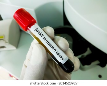 Scientist Hold Blood Sample For Jack2 Mutation Test, To Help Diagnose Bone Marrow Disorders Known As Myeloproliferative Neoplasms (MPNs)