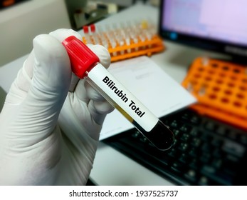 Scientist Hold Blood Sample For Total Bilirubin Test