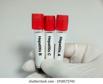 Scientist Hold Blood Samples For Hepatitis Virus Test (Hepatitis A, Hepatitis B, Hepatitis C)