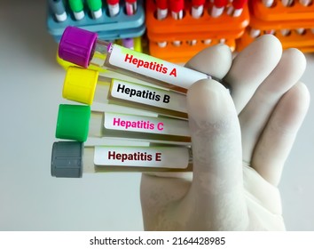 Scientist Hold Blood Samples For Hepatitis Virus Test (Hepatitis A, B, C And E)