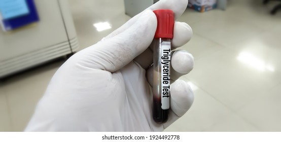 Scientist Hold Lipemic Blood Sample, High Triglyceride Contain Serum Sample. Lipemia In A Blood Specimen Can Cause Significant Interference With Obtaining Accurate Lipid Profile Test Values