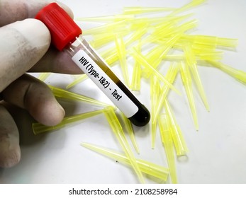 Scientist Hold Test Tube With Blood Sample For HIV Type 1 And HIV Type 2 Antibody Testing, Hiv Screening Test