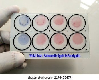 Scientist Hold Testing Plate For Widal Test By Agglutination Method With Lab Background, To Diagnosis Typhoid And Paratyphoid Fever At Laboratory, Salmonella Bacteria Disease Testing