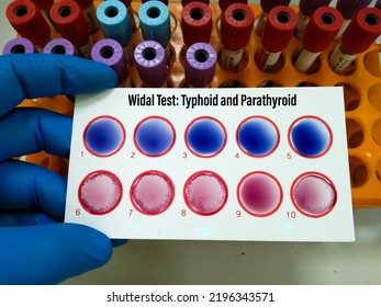 Scientist Hold Testing Plate For Widal Test By Agglutination Method With Lab Background, To Diagnosis Typhoid And Paratyphoid Fever At Laboratory, Salmonella Bacteria Disease Testing