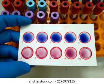 Scientist Hold Testing Plate For Widal Test By Agglutination Method With Lab Background, To Diagnosis Typhoid And Paratyphoid Fever At Laboratory, Salmonella Bacteria Disease Testing