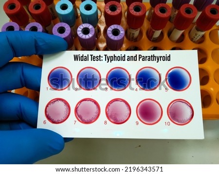 Scientist hold testing plate for Widal test by agglutination method with lab background, to diagnosis Typhoid and Paratyphoid fever at laboratory, Salmonella bacteria disease testing