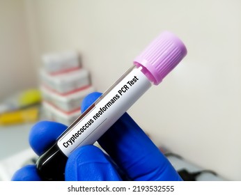 Scientist Holding Blood Sample For Cryptococcus Neoformans PCR Test.