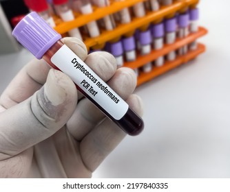 Scientist Holding Blood Sample For Cryptococcus Neoformans PCR Test.