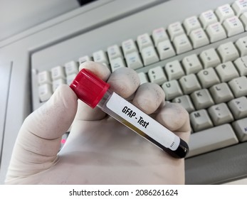 Scientist holding blood sample for GFAP(glial fibrillary acidic protein) test, intracerebral hemorrhage in patients with symptoms suspicious of acute stroke.