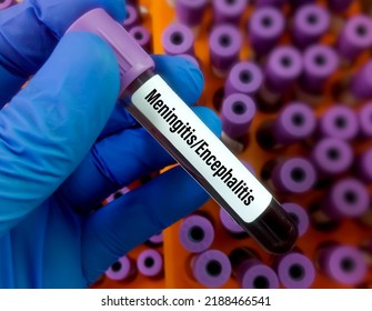 Scientist Holding Blood Sample For Meningitis Or Encephalitis PCR Test