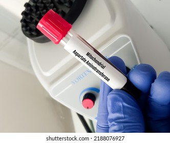 Scientist Holding Blood Sample For Mitochondrial Aspartate Aminotransferase(mAST) Test. Chronic Alcoholism. Liver Disease.