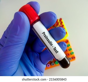 Scientist Holding Blood Sample For Proinsulin Test.