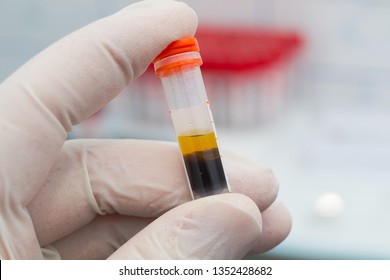 Scientist Holding In His Hand A Centrifuged Blood Sample With Hemolysis