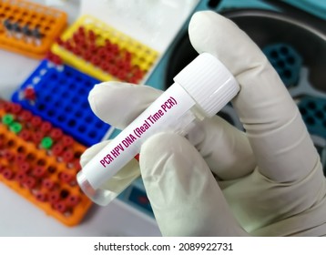 Scientist Holding Sample Container Cervical Fluid Sample For PCR HPV DNA (real Time PCR) Test, Human Papilloma Virus, Cervical Cancer. A Medical Testing Concept In The Laboratory