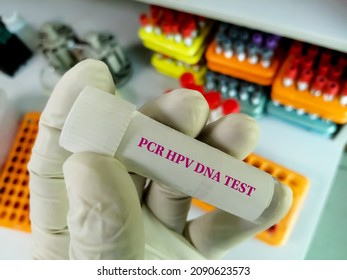 Scientist Holding Sample Container With Cervical Fluid Sample For PCR HPV DNA Test, Human Papilloma Virus, Cervical Cancer. A Medical Testing Concept In The Laboratory