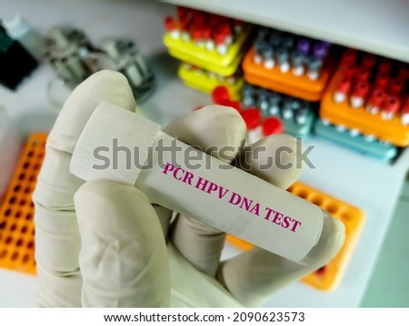 Scientist holding sample container with Cervical Fluid sample for PCR HPV DNA test, Human papilloma virus, cervical cancer. A medical testing concept in the laboratory