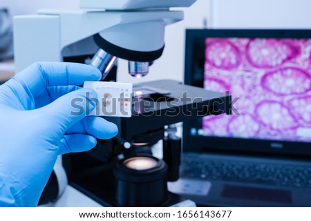 Scientist wear blue glove holding parafin human tissue block and out of focus microscope and computer monitor show glandular image.Medical patholology and cytology laboratory technology concept.