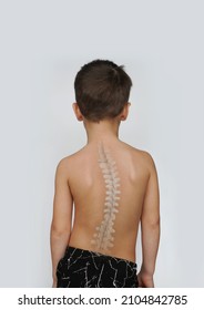 Scoliosis Spine Curve Anatomy, Posture Correction. Child with a deviated spine