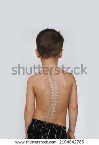 Scoliosis Spine Curve Anatomy, Posture Correction. Child with a deviated spine