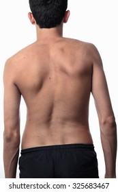 Scoliosis, Thin Man On His Back, No Shirt. Curvature Of The Spine Visible