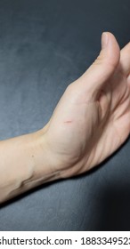 Scotch Tape Cutter Scar On Woman's Left Hand