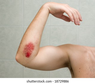 Scraped elbow - the result of inline skating accident. The wound is covered with antibacterial gel