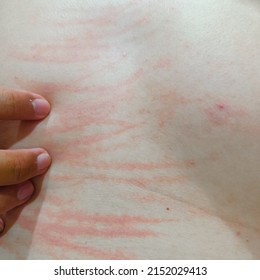 Scratch scars on the skin of a white Asian man