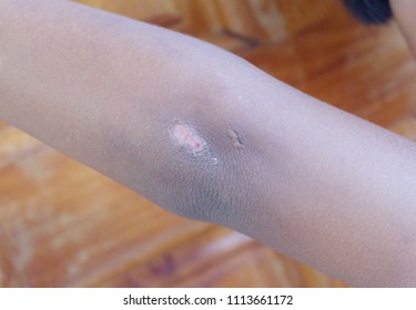 the scratched wound on elbow.