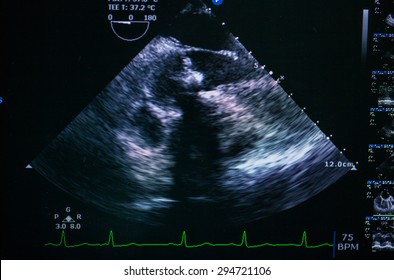 Screen Of Echo-cardiography (ultrasound) Machine. 