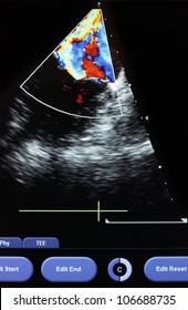 Screen Of  Ultrasound Machine. Echocardiography - Doppler Echocardiogram. Photos.
