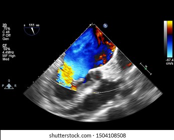 Screen of an ultrasound machine with a heart image.