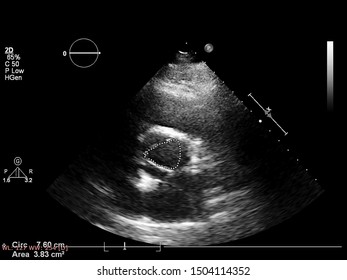 Screen Of An Ultrasound Machine With A Heart Image.