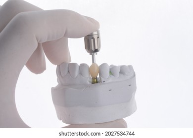 Screw type dental crown on dental implant with white background.